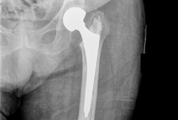Femoral head fracture